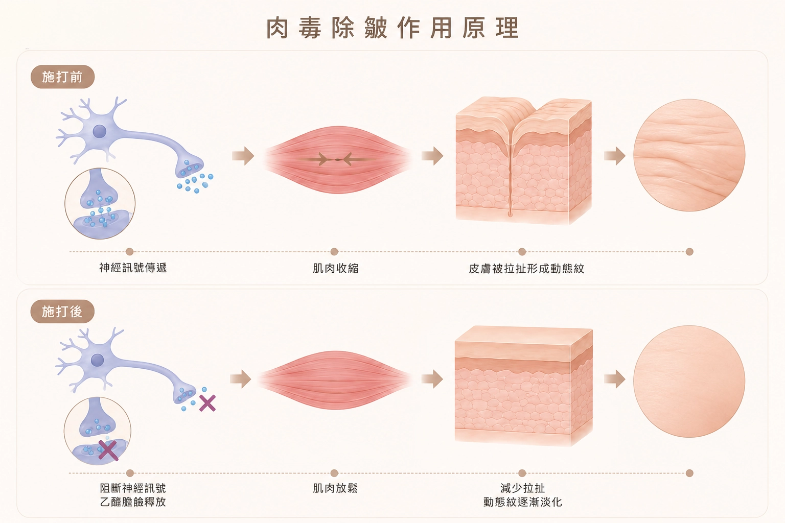 肉毒除皺 3 肉毒除皺作用原理圖解:施打前後神經訊號傳遞與肌肉收縮的差異