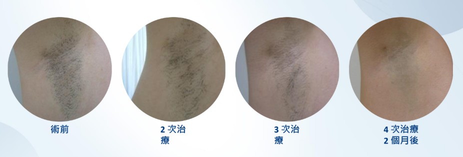 雷射除毛 5 腋下毛髮雷射術前、二次、三次與四次療程後兩個月對照示意